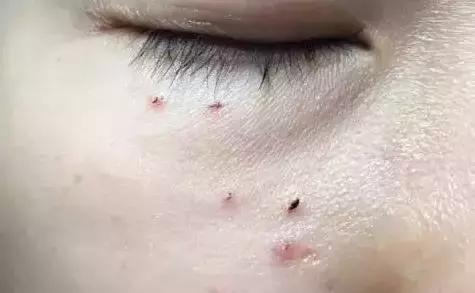 脂肪粒可以挤掉吗，脂肪粒可以手动挤出吗（小心与HPV病毒相关）