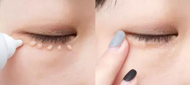 脂肪粒可以挤掉吗，脂肪粒可以手动挤出吗（小心与HPV病毒相关）