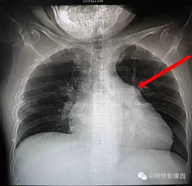 肺栓塞怎么检查，怎么样检查才可以查出肺栓塞（其实 7 个检查就搞定）