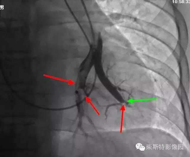 肺栓塞怎么检查，怎么样检查才可以查出肺栓塞（其实 7 个检查就搞定）