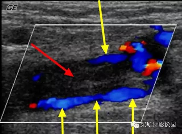 肺栓塞怎么检查，怎么样检查才可以查出肺栓塞（其实 7 个检查就搞定）