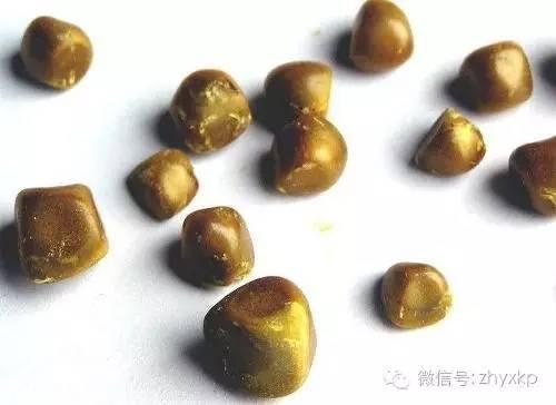 肥胖容易得结石(肥胖的人容易长结节吗)