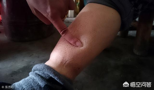  腿肿是心衰的几级，心衰造成的腿肿