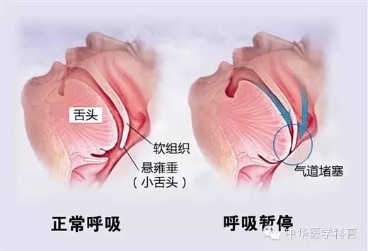 肥胖继发症(肥胖的并发症和后遗症)