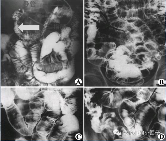 小肠内有什么消化器官，你了解和不了解的\