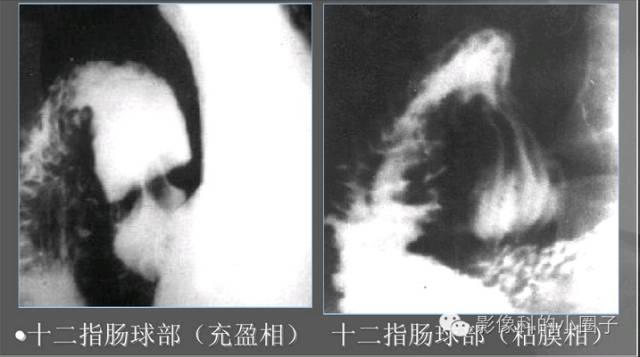 小肠内有什么消化器官，你了解和不了解的\