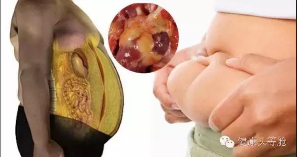 肥胖内脂图片(肥胖人体内脂肪解剖图片)