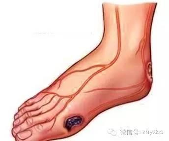 糖尿病并发症有哪些(糖尿病并发症有尿毒症吗)