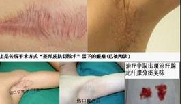 腋臭术后腋下颜色深红正常吗(腋臭手术后腋窝黑黑的皱皱的)