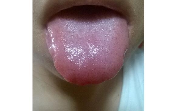 舌头有什么症状图解，舌头不同症状透露身体情况