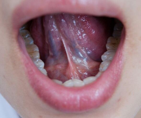 舌头有什么症状图解，舌头不同症状透露身体情况