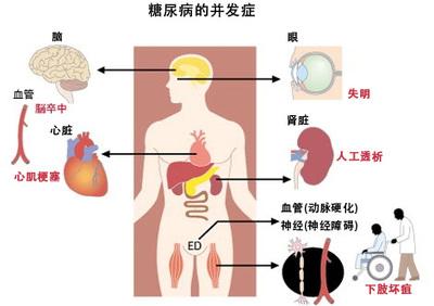 高渗性非酮症糖尿病(高渗性非酮症糖尿病昏迷)