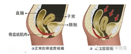 修复盆底肌的简单动作，四个简单动作练起来