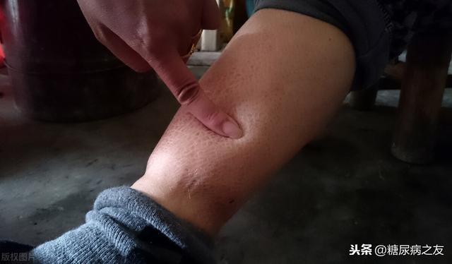 糖尿病有水肿(糖尿病水肿是肾病几期)
