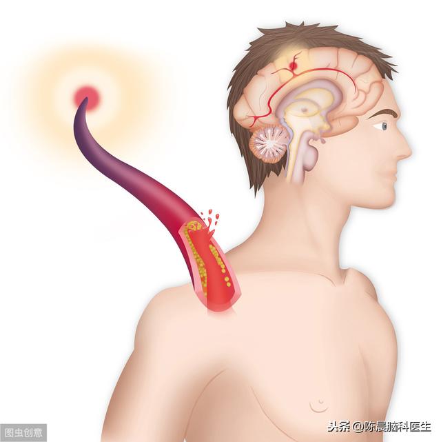 脑梗死和糖尿病(脑梗死和糖尿病的关系)