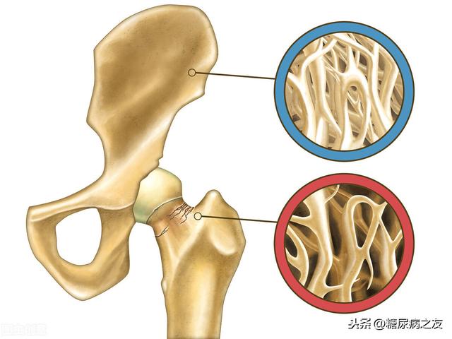 糖尿病会引起腰酸吗(腰疼和血糖高有关系吗)