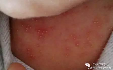 一分钟教你辨别湿疹和热疹，热疹湿疹不要傻傻分不清