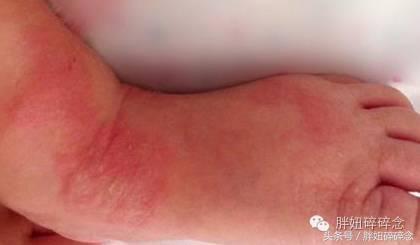 一分钟教你辨别湿疹和热疹，热疹湿疹不要傻傻分不清
