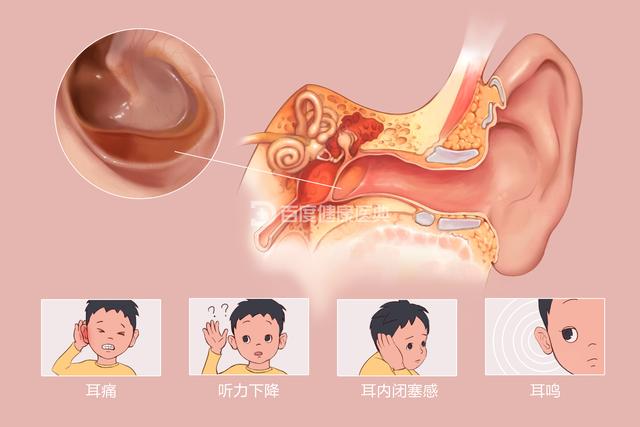 儿童分泌性中耳炎，儿童为什么会得分泌性中耳炎（警惕小儿中耳炎）