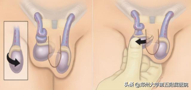 急性睾丸扭转百科，“蛋蛋”疼？小心急性睾丸扭转