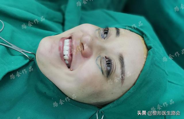 膨体填充泪沟失败案例，小助理欢欢同你聊一聊