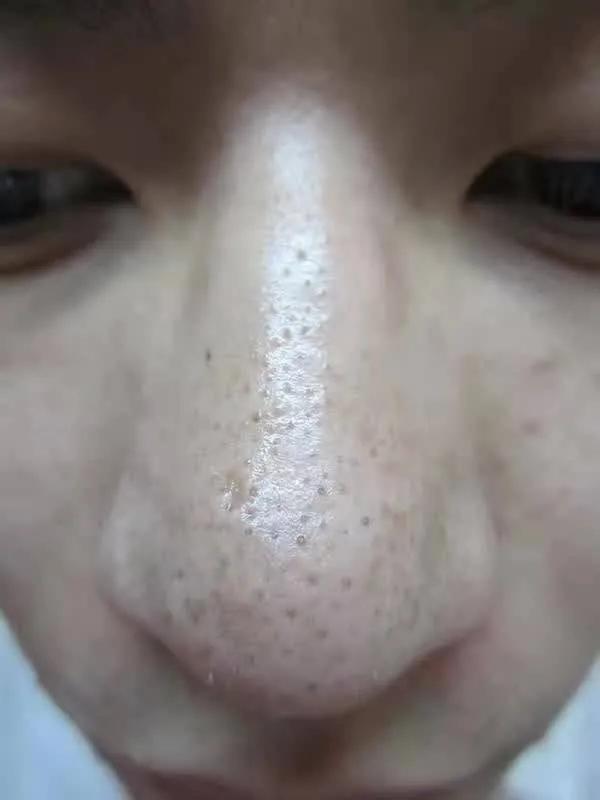 清理黑头的正确方法，黑头清理办法大全