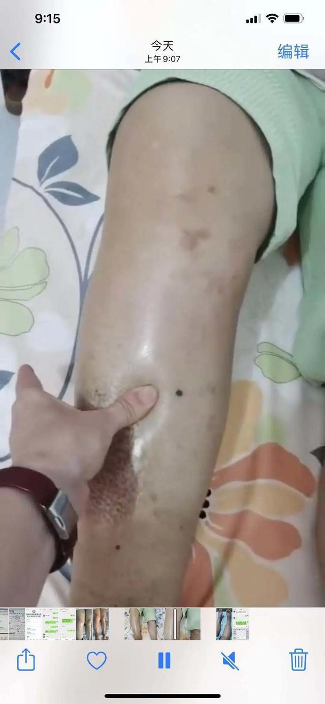肥胖 腿肿(肥胖导致腿肿)