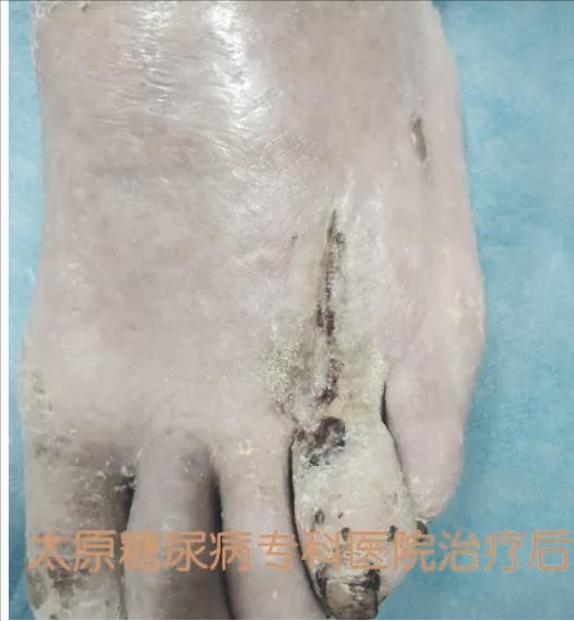 糖尿病换药(糖尿病换药注意事项)