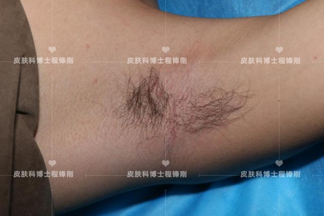 男孩腋臭用什么办法根除(男孩腋臭怎么办)