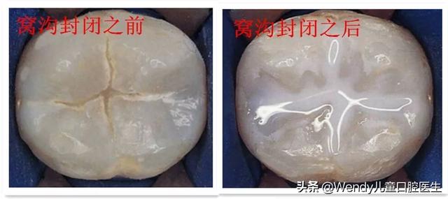 一张刷爆朋友圈的牙片，成年人要做牙齿窝沟封闭