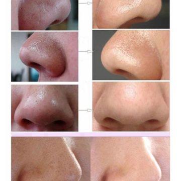 用什么牙膏能消除黑头，告诉你妙用牙膏去黑头的小方法