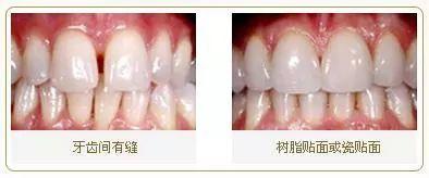 牙缝大能补吗怎么补能用多久，牙缝大可以补吗