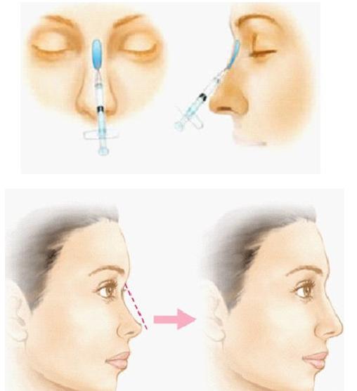 隆鼻用什么填充材料好，隆鼻填充物有哪些