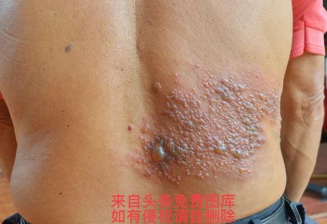 带状疱疹最好的治疗方法，带状疱疹的最佳治疗方法