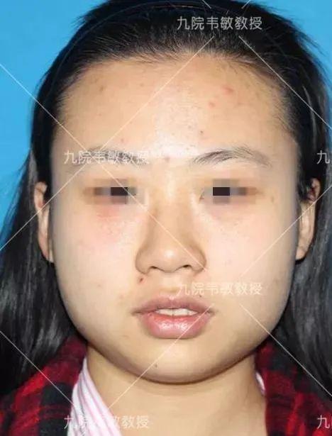 磨除女人肥胖下颌角