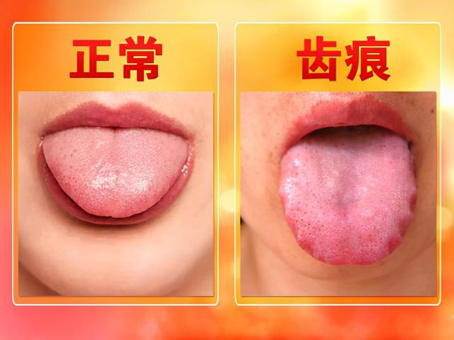 湿气重起肥胖(湿气重肥胖吃什么药最好最有效)