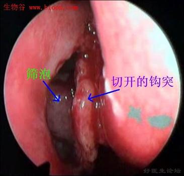 鼻部结构示意图，包括炎症、肿块、鼻腔结构变化