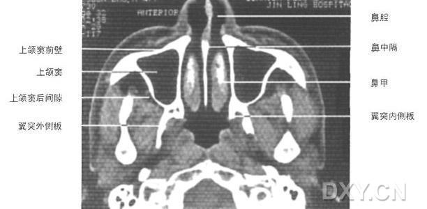 鼻部结构示意图，包括炎症、肿块、鼻腔结构变化