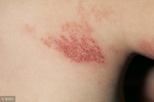 带状疱疹要忌口哪些食物吗，带状疱疹要忌口吗