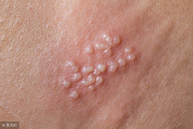 带状疱疹要忌口哪些食物吗，带状疱疹要忌口吗