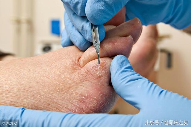 7糖尿病足(糖尿病足严重吗?怎么治疗?)
