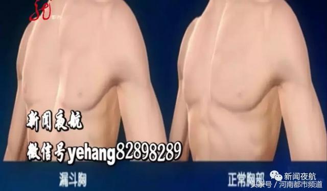 肥胖漏斗胸案例(漏斗胸的人怎么吃胖)
