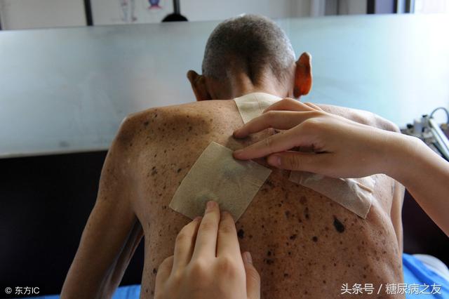 糖尿病三伏贴穴位(糖尿病三伏贴怎么贴)