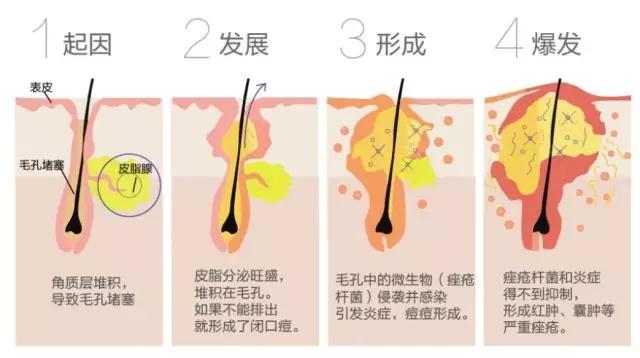 祛痘最有效的方法2天见效，用我多年的血泪史告诉你们