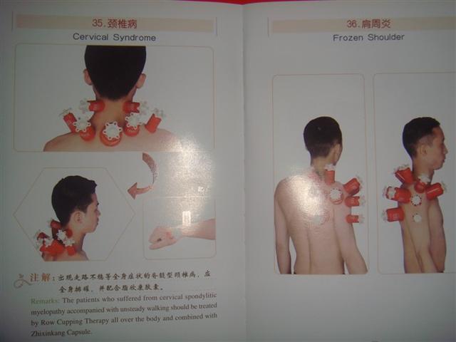 常见拔罐方法有哪三种，拔罐疗法你了解多少