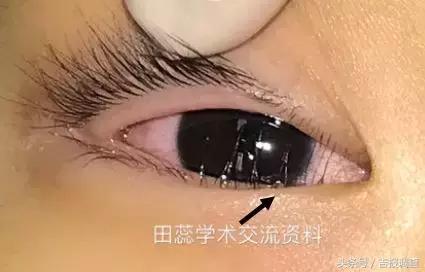 睫毛生长纹肥胖(睫毛长会影响视线吗)