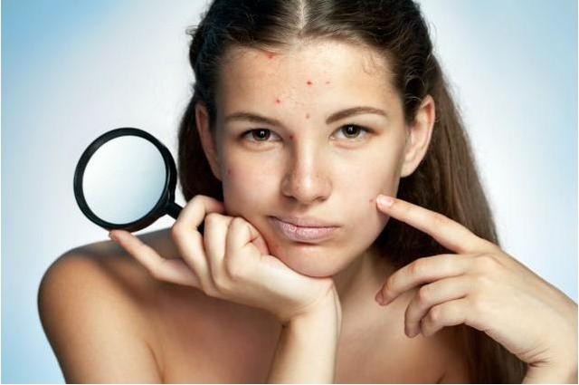 青春痘留疤痕多久能消除，青春痘疤痕小百科