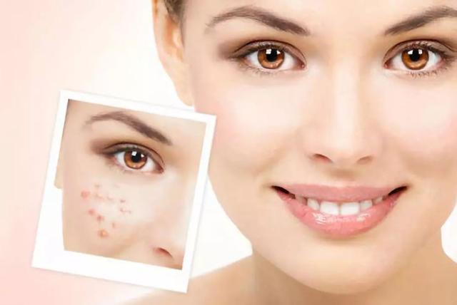 青春痘留疤痕多久能消除，青春痘疤痕小百科