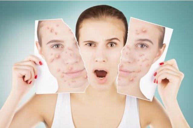 青春痘留疤痕多久能消除，青春痘疤痕小百科