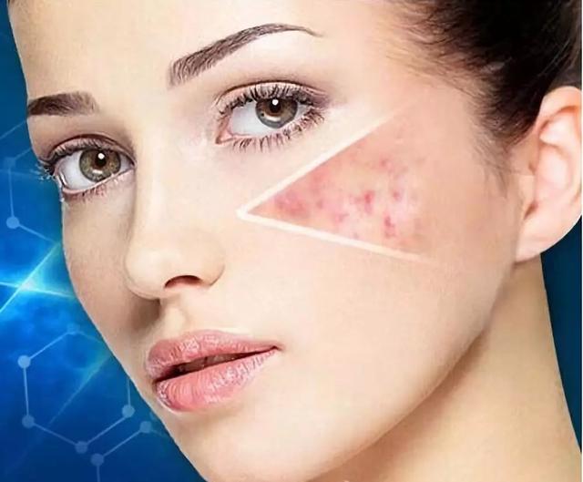 青春痘留疤痕多久能消除，青春痘疤痕小百科